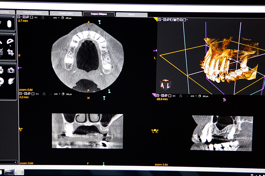 歯科用CTによる正確な診断