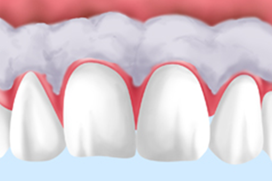 歯ぐきの黒ずみを解消するピーリング