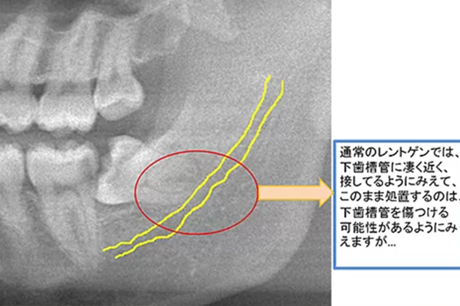 歯科用CTで精密診断を行います