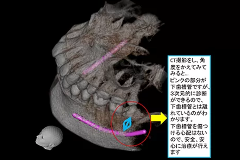 歯科用CTで精密診断を行います