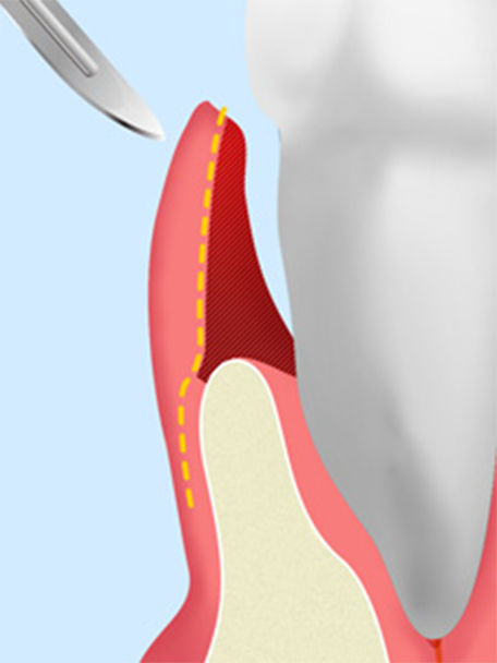 APF（歯肉弁根尖側移動術）